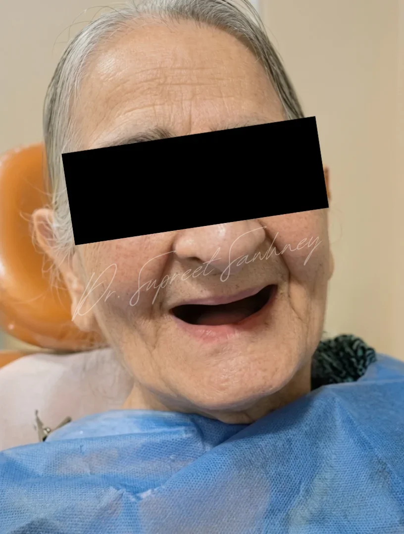 Patient seated in a dental chair before denture insertion, with eyes obscured for privacy